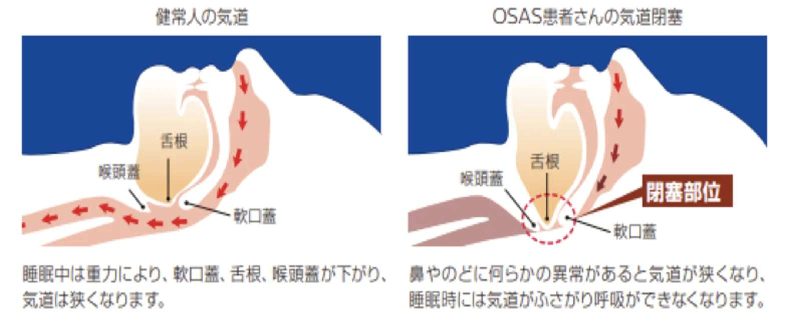 睡眠時無呼吸症候群（SAS）の原因は何ですか？