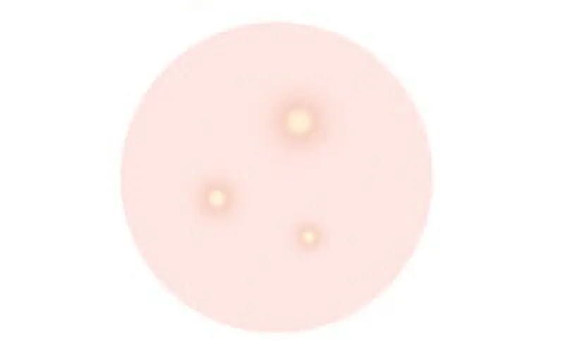 白ニキビ（白色面皰）