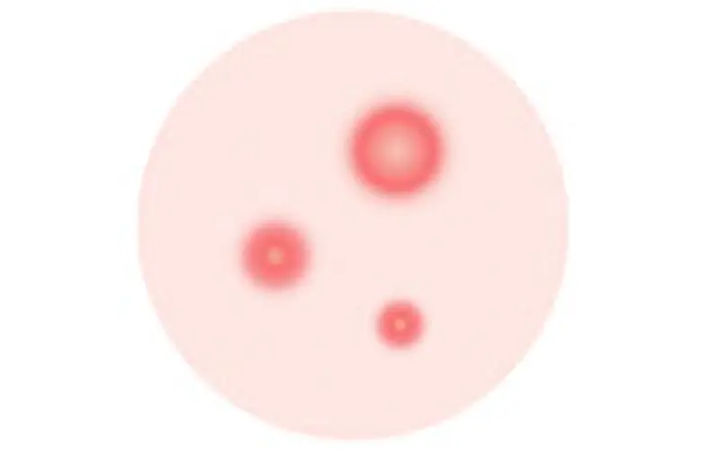 赤ニキビ（赤色面皰）