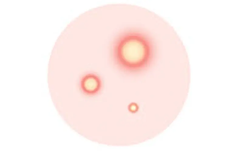 黄ニキビ（膿疱）